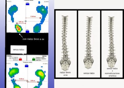 Fisioterapia Avellino Casi clinici