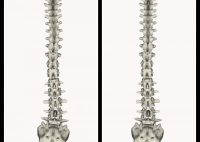 Fisioterapia Avellino casi clinici